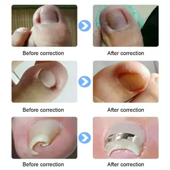 Коректор за врастнали нокти на краката Инструмент за изправяне на нокти от неръждаема стомана за Улесняване на болката Педикюрный инструмент за възстановяване на врастнали нокти на краката